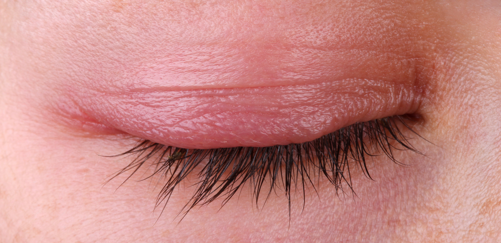 Close-up of a closed, red, and irritated eye from a patient suffering from blepharitis.