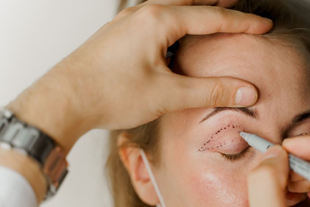 Patient having their eyelid drawn on in preparation for a reconstructive blepharoplasty to improve vision.
