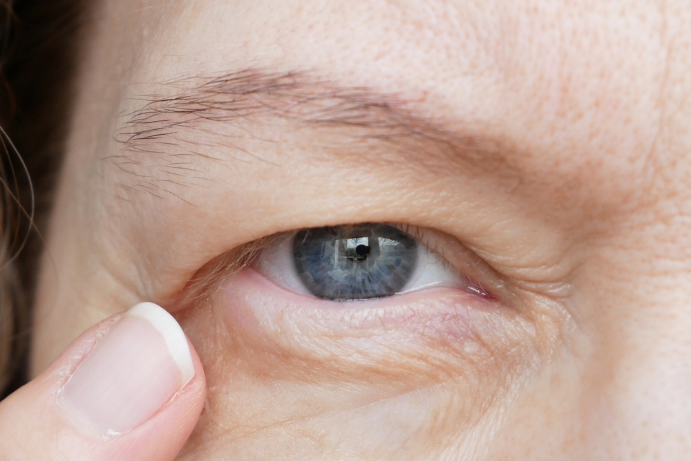 Close-up of an older person's eye with heavy, drooping lids, in need of a blepharoplasty.